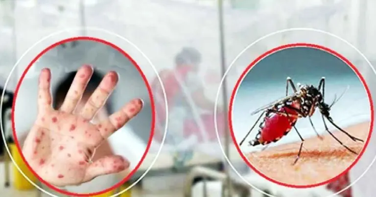 একদিনে ডেঙ্গুতে হাম উপসর্গে ৫ জনের মৃত্যু